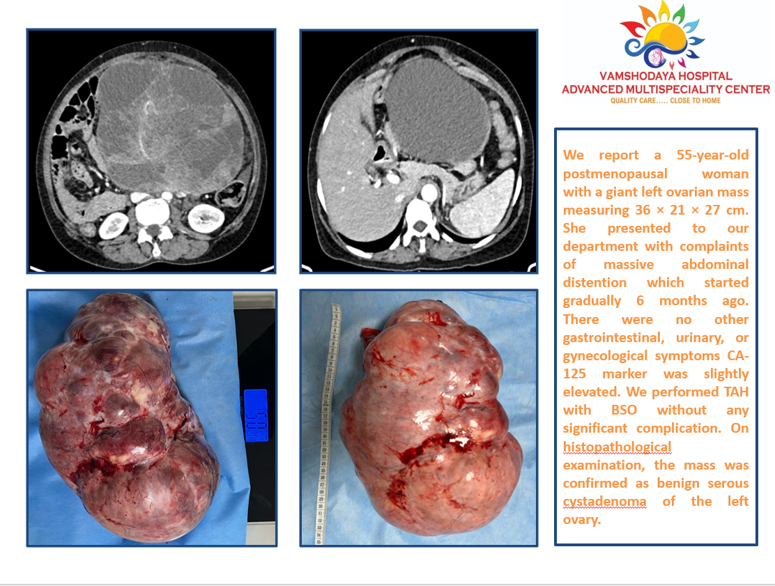 Ovarian tumor
